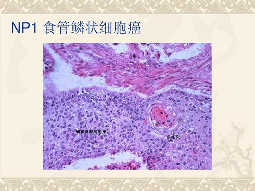 食管鱗癌